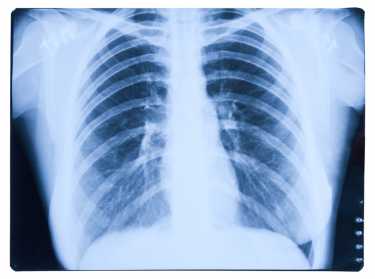 早期检测COPD可以帮助预防肺癌