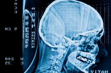 美国青年运动员创伤性脑损伤增加了60%